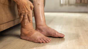 Headline: Silent Signals: 7 Early Warning Signs of Kidney Damage and Nephrosis Onset