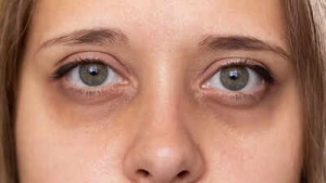 Dark Circles Under Eyes: A Warning Sign of Kidney, Liver Issues, or Other Health Problems?