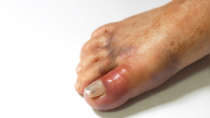 High Uric Acid and Your Skin: Spotting the 5 Key Warning Signs