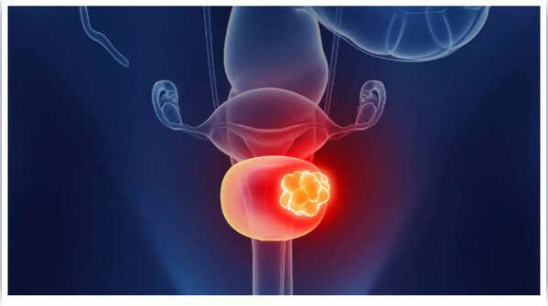 Woman experiencing lower back and pelvic pain, a symptom of advanced bladder cancer