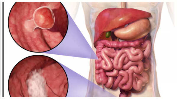 Image depicting blood in stool