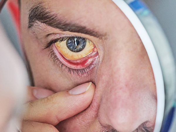Jaundice: Yellowing of the eyes and skin