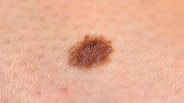 Detecting pigment spreading from a mole
