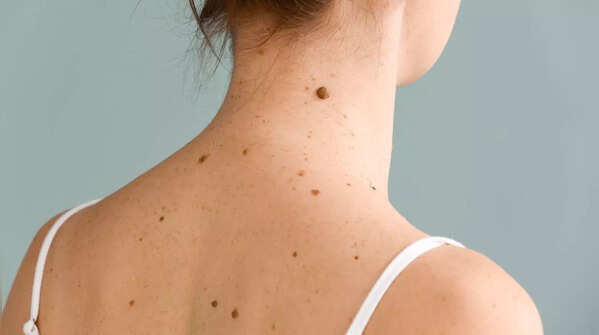 Monitoring new moles, growths, and bumps
